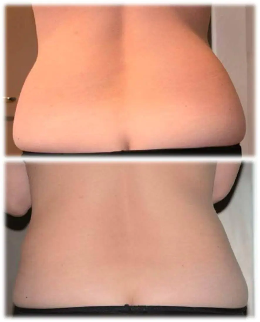 ד"ר רון טנצר - ניתוח הצמדת אוזניים