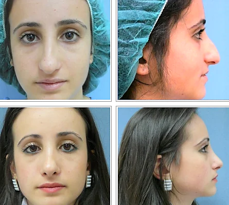 ד"ר רונן גלזינגר - המסת שומן בגלי רדיו ד"ר רונן גלזינגר - המסת שומן בגלי רדיו