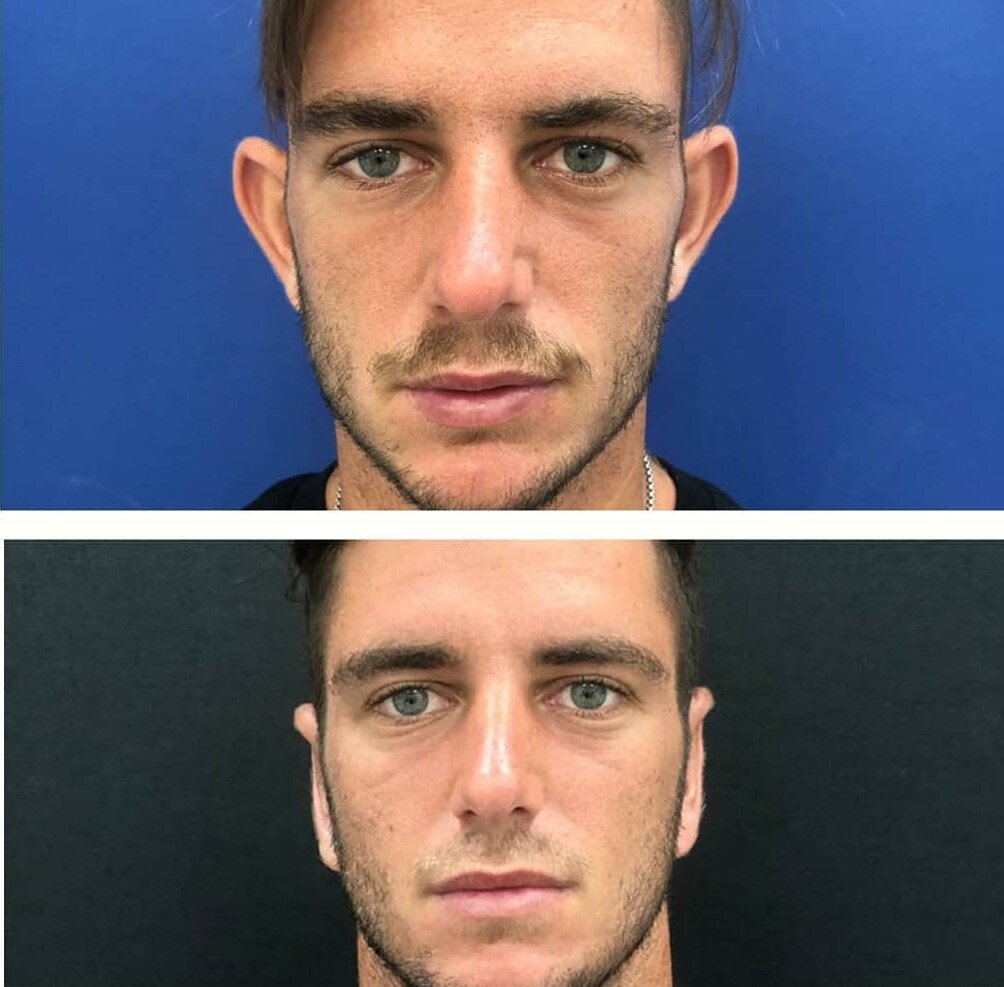 ד"ר רון טנצר - ניתוח הצמדת אוזניים