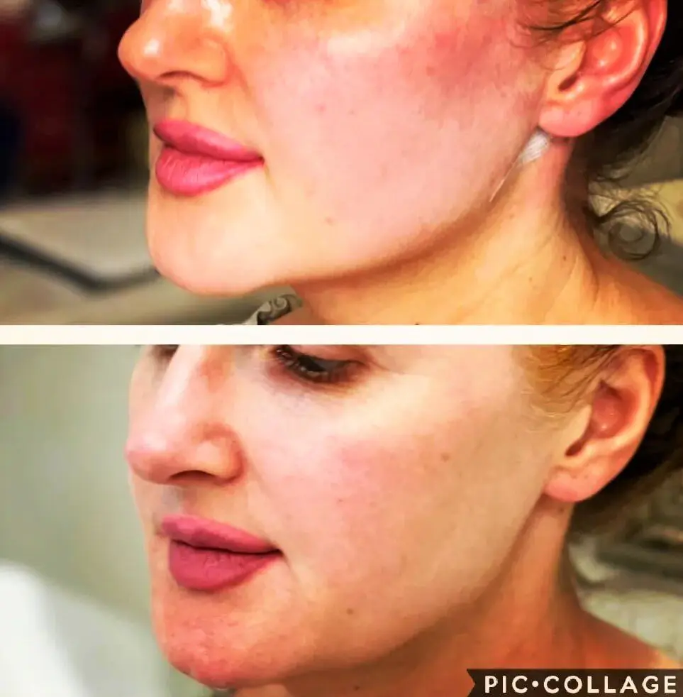 ד"ר אמין שעלאן - פיסול פנים ומילוי קמטים