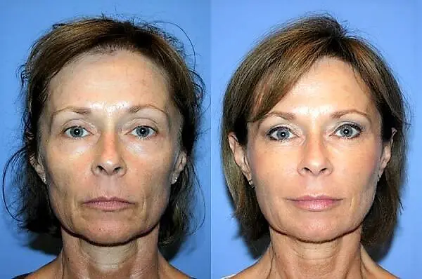 ד"ר רונן גלזינגר - המסת שומן בגלי רדיו ד"ר רונן גלזינגר - המסת שומן בגלי רדיו