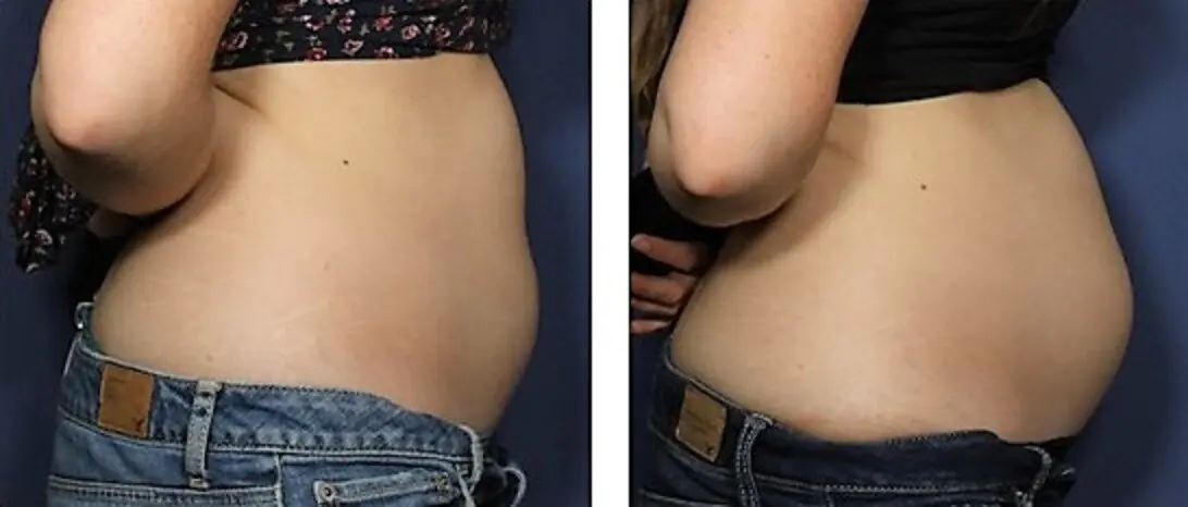 ד"ר רונן גלזינגר - המסת שומן בגלי רדיו ד"ר רונן גלזינגר - המסת שומן בגלי רדיו