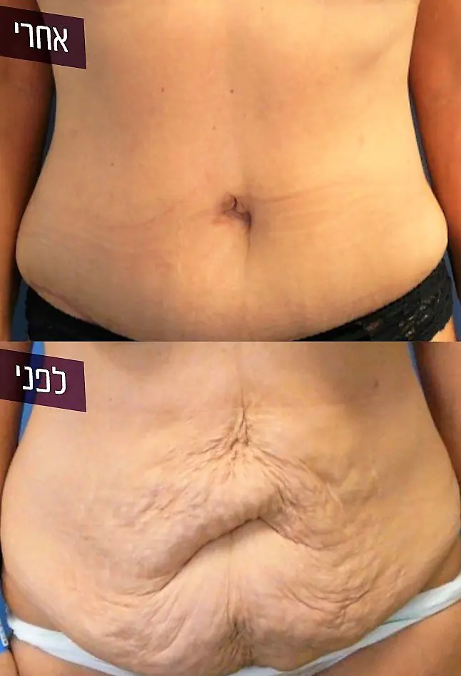 ד"ר רונן גלזינגר - המסת שומן בגלי רדיו ד"ר רונן גלזינגר - המסת שומן בגלי רדיו