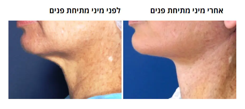 ד"ר רונן גלזינגר - המסת שומן בגלי רדיו ד"ר רונן גלזינגר - המסת שומן בגלי רדיו