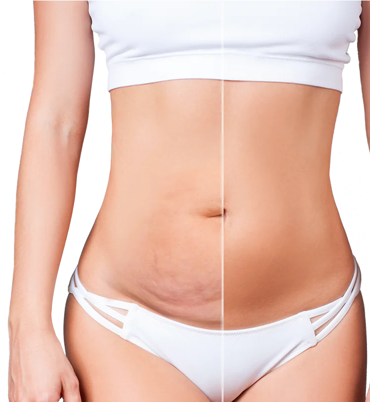 ד"ר רונן גלזינגר - המסת שומן בגלי רדיו ד"ר רונן גלזינגר - המסת שומן בגלי רדיו