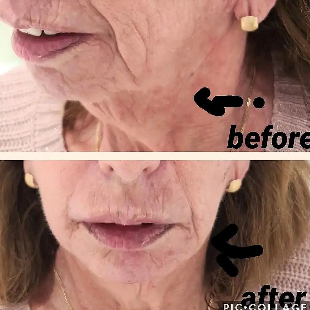 ד"ר אמין שעלאן - פיסול פנים ומילוי קמטים