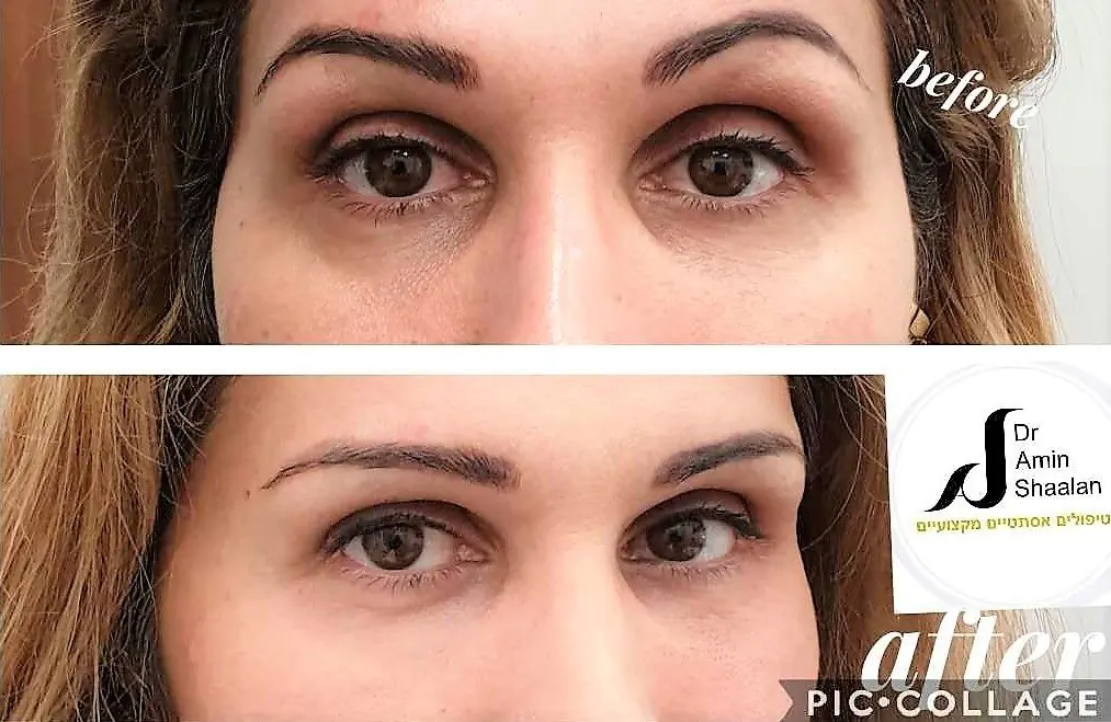 ד"ר אמין שעלאן - פיסול פנים ומילוי קמטים