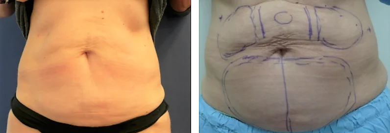 ד"ר רונן גלזינגר - המסת שומן בגלי רדיו ד"ר רונן גלזינגר - המסת שומן בגלי רדיו