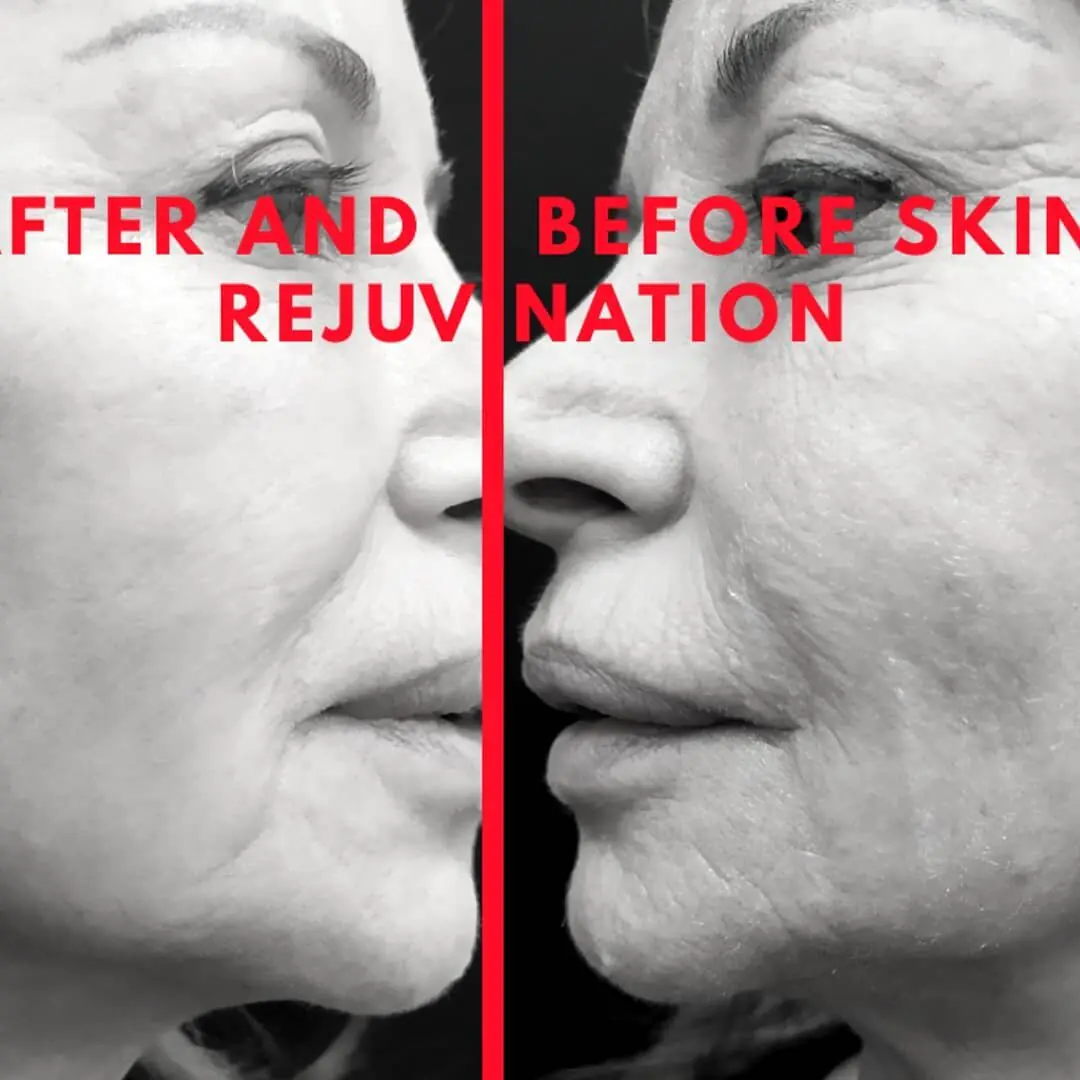 ד"ר רון טנצר - ניתוח הצמדת אוזניים