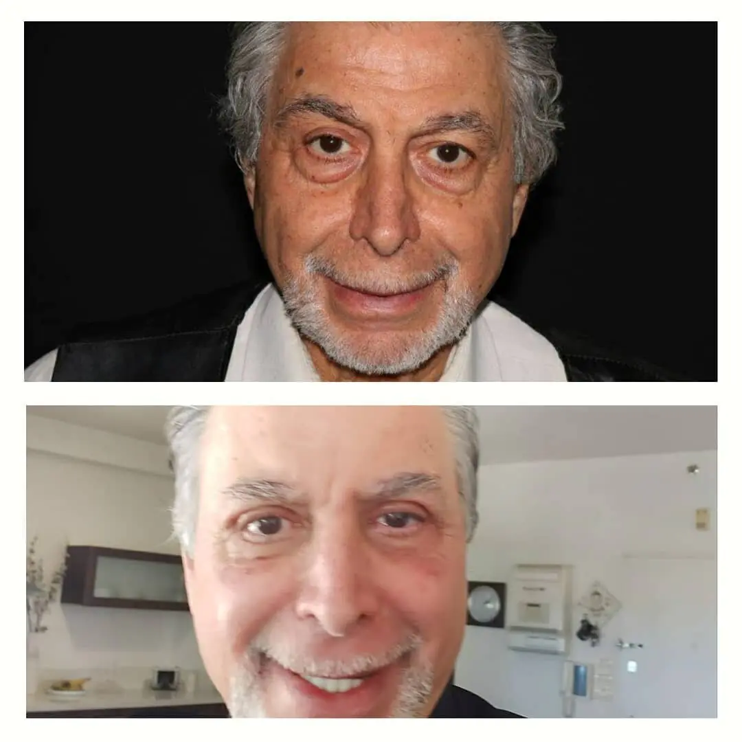 ד"ר רון טנצר - ניתוח הצמדת אוזניים