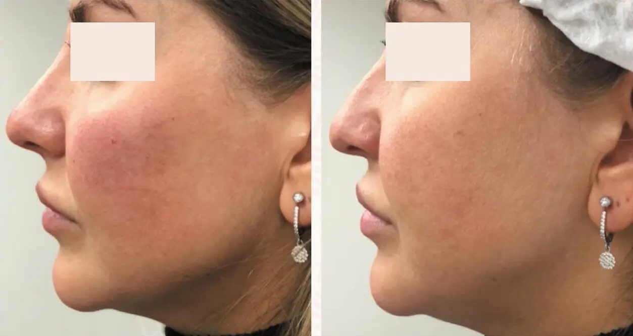 יפה מקסימוב - עיצוב שפתיים 